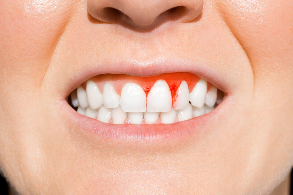 Periodontal Disease in Buckeye, AZ